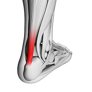 Чому болить ахілл після бігу
